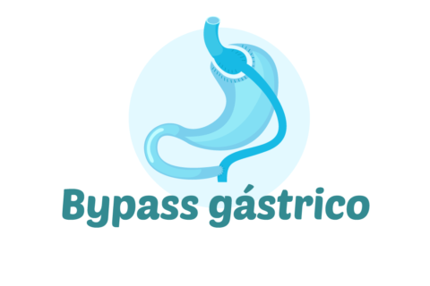 BYPASS GÁSTRICO