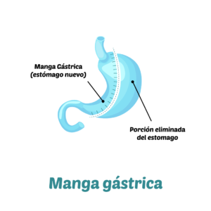 Manga Gástrica, Cirugía Bariátrica