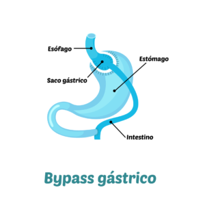 Bypass Gástrico, Cirugía Bariátrica