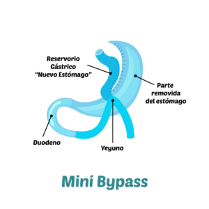 Mini Bypass, Cirugía Bariátrica