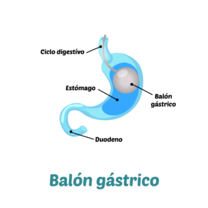 Balón Gástrico, Cirugía Bariátrica